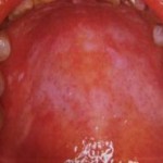 odontologia online leucoplasia sifilis palatina