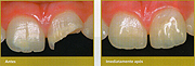 odontologia online dente quebrado